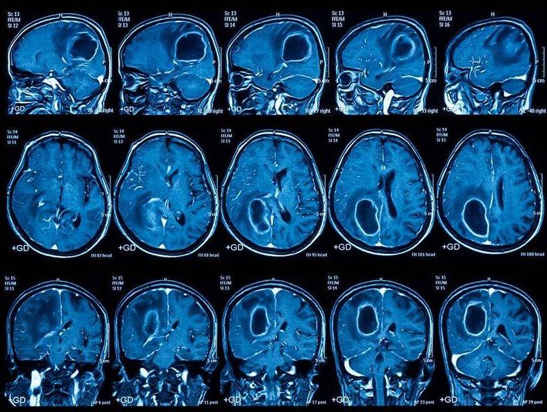 Опухоль головного мозга на снимках МРТ